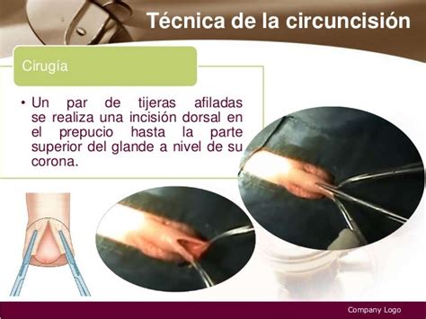 postoperatorio circuncisin fotos|Circuncisión: qué es, riesgos, beneficios y。